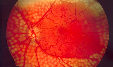 Retinopatia diabetica